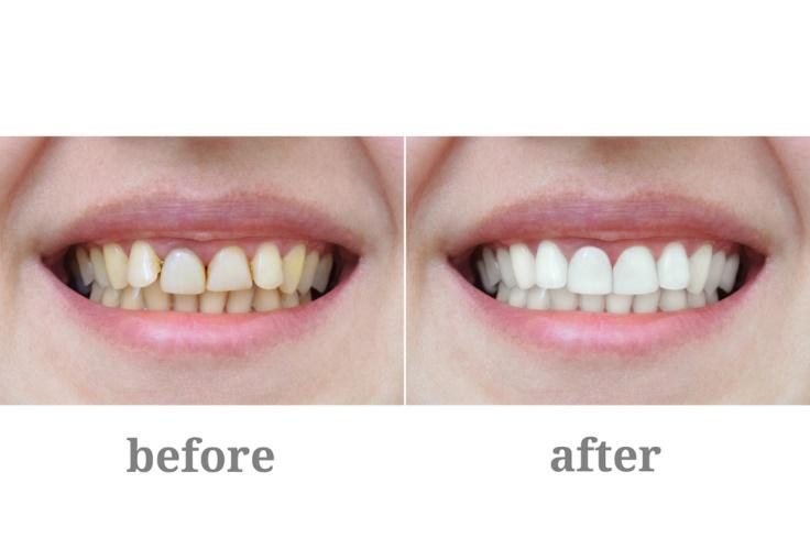 Before and after comparison of teeth whitening treatment showing improved tooth color and brightness.