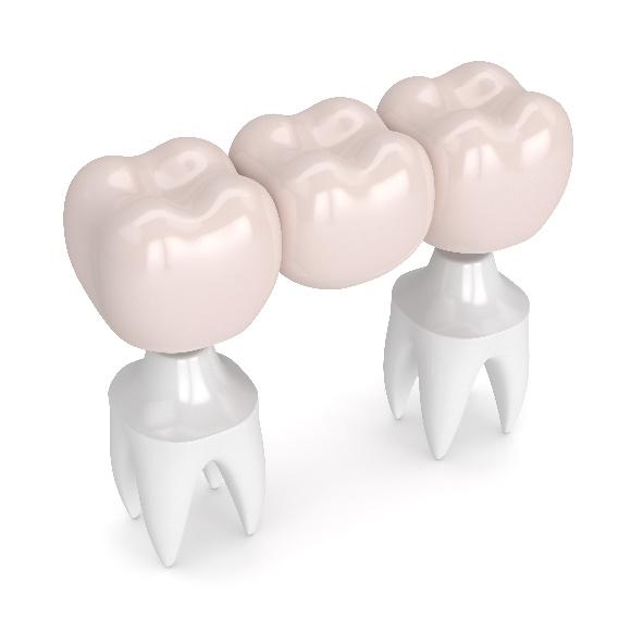 Three dental crowns displayed on tooth-shaped models showing restorative dentistry options.