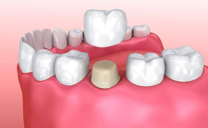 Dental crown procedure illustration showing tooth replacement among natural teeth on pink gum model.