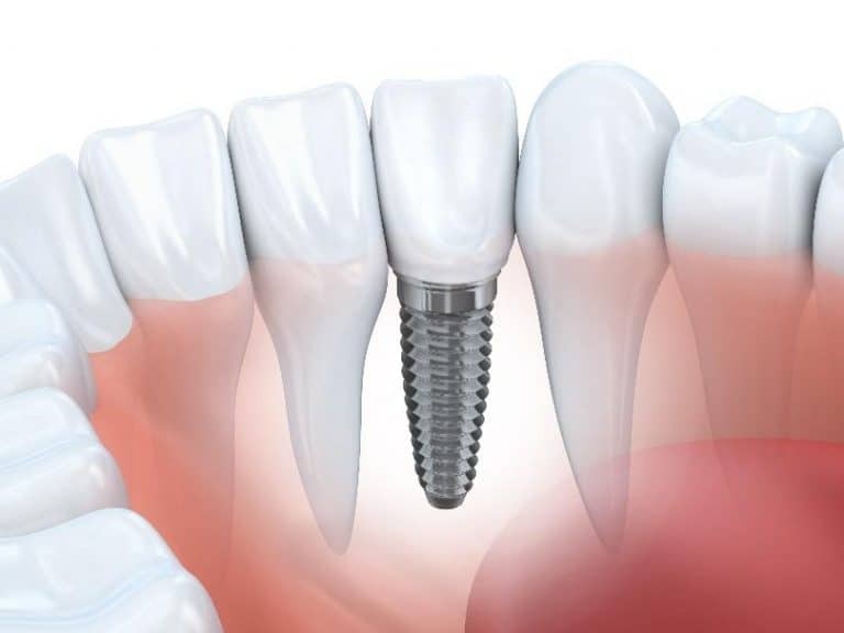 Dental implant illustration showing a titanium screw between natural teeth and gum tissue.
