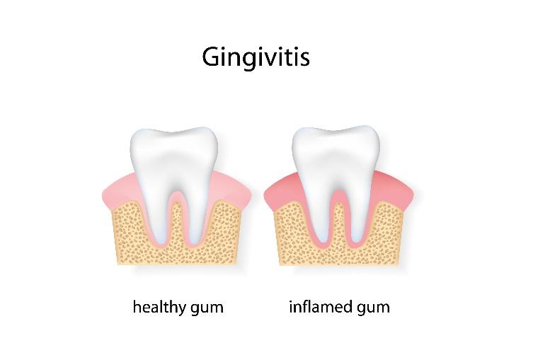 Comparison diagram showing healthy pink gum tissue versus inflamed red gum tissue affected by gingivitis.