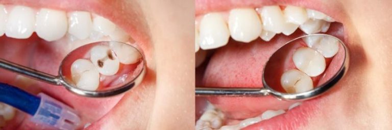 Before and after dental treatment showing tooth restoration with toothbrush in mouth