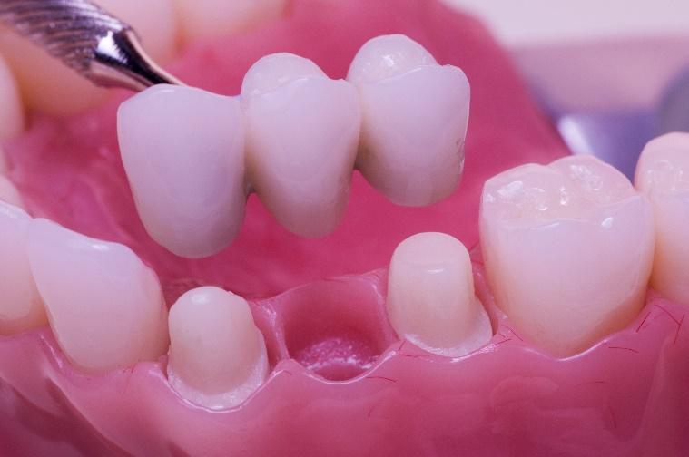 Dental model displaying tooth crowns and implants on pink training fixture for cosmetic dentistry demonstration.