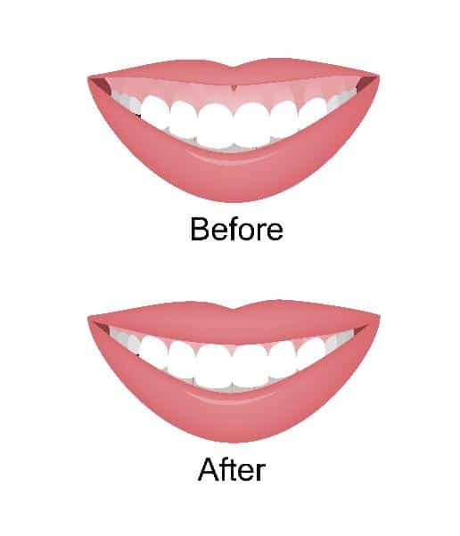 Before and after comparison of smile design showing improved tooth alignment and gum contour.