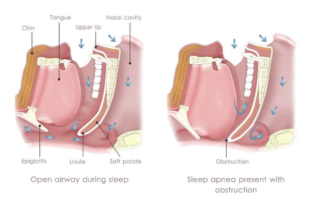 Medical diagram comparing open airway during sleep versus sleep apnea with obstruction.