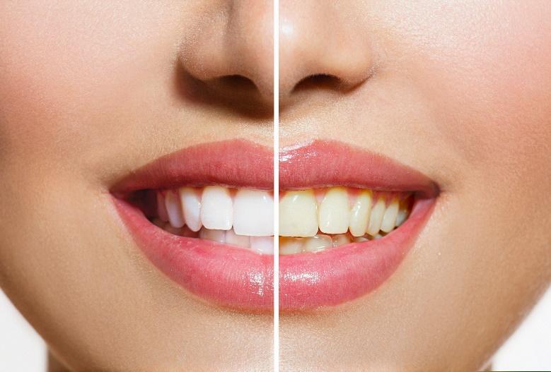 Before and after teeth whitening comparison showing brighter, whiter smile results.