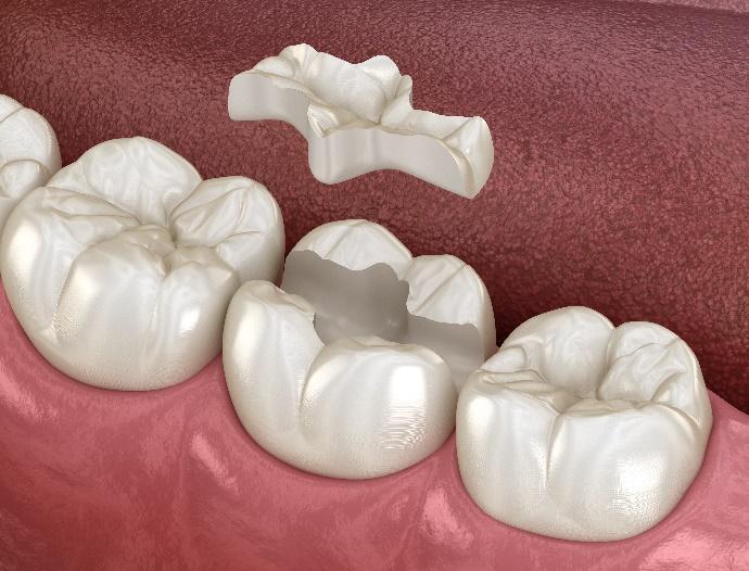 Dental crowns and bridge model displayed on pink surface showing restorative dentistry options.
