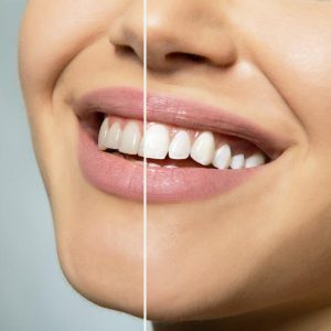 Before and after smile comparison showing teeth whitening results in La Jolla.