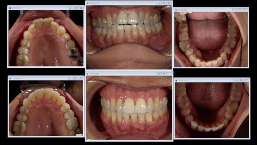 Before and after dental treatment comparison showing upper and lower palate views and smile results.