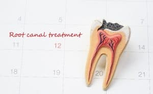 Dental cross-section model showing root canal treatment procedure on calendar background.