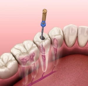 Dental implant procedure illustration showing surgical drill inserting implant post into jawbone model against pink background.