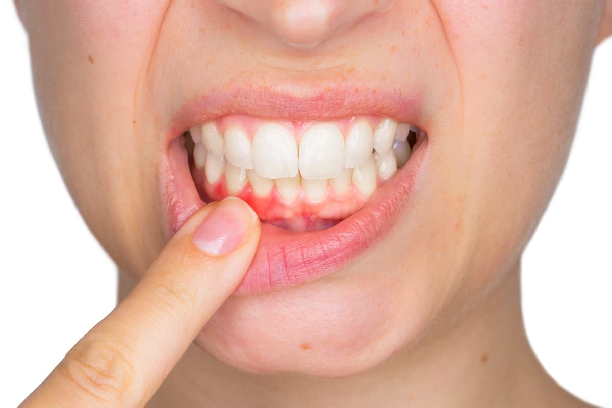 Person pointing to inflamed gum line while smiling, demonstrating gum disease symptoms.
