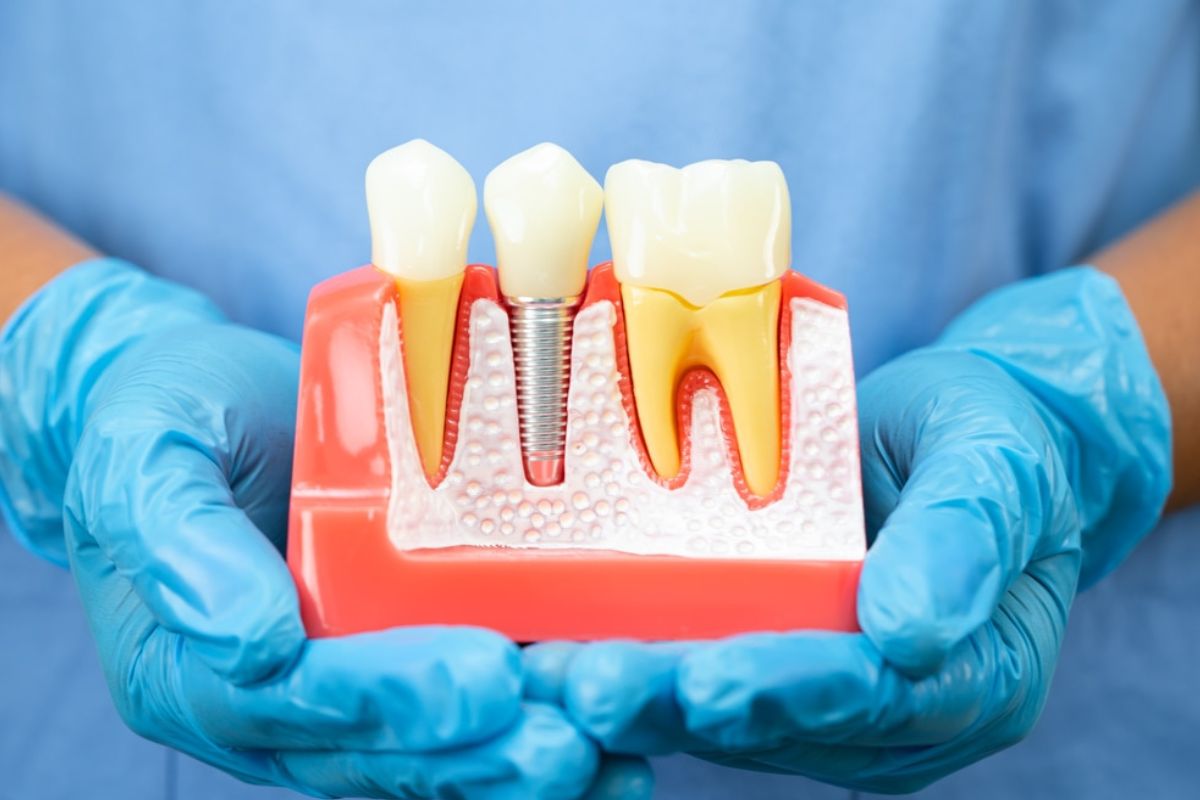 How Long Do Dental Implants in La Jolla, CA Lasts