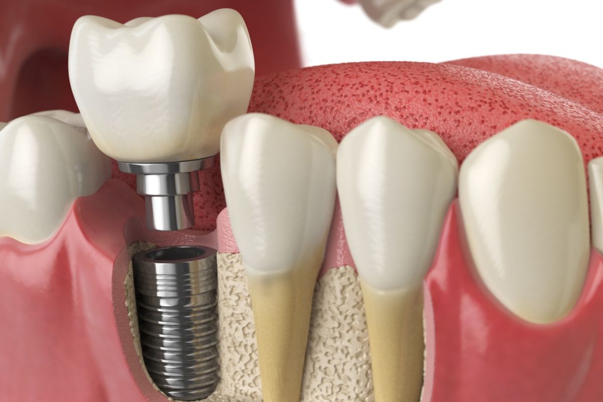 Loose or Painful Dental Implant? What You Should Do