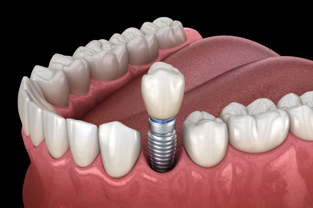 How Many Missing Teeth Can Dental Implants Replace?