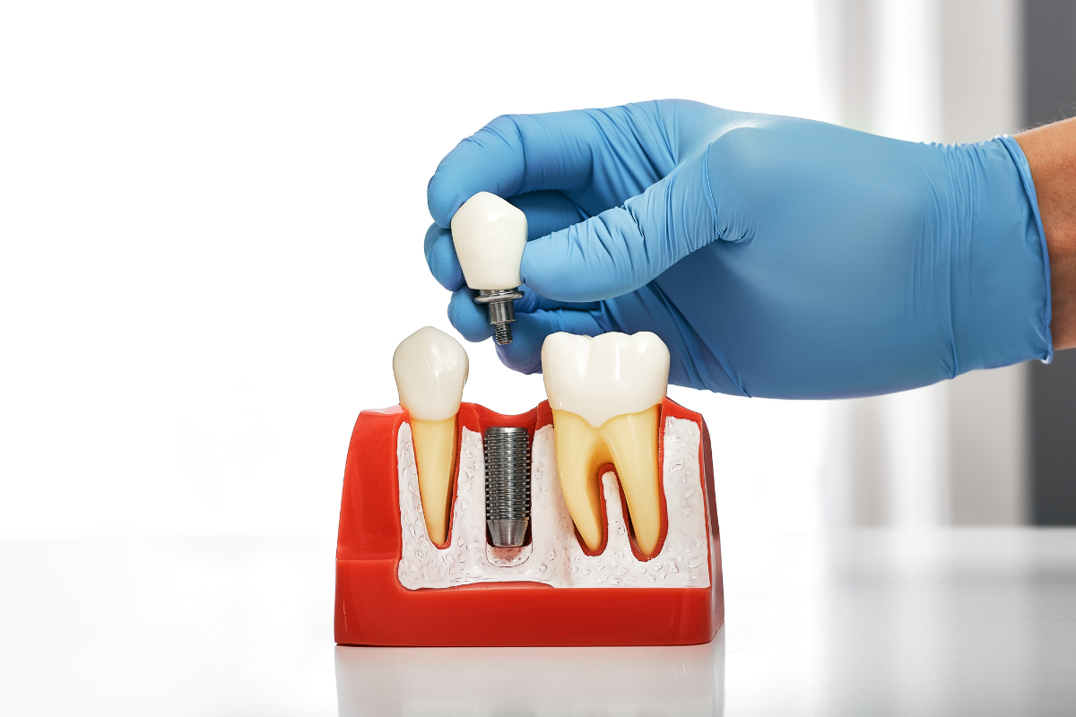 Delaying Tooth Replacement? Consider Dental Implants