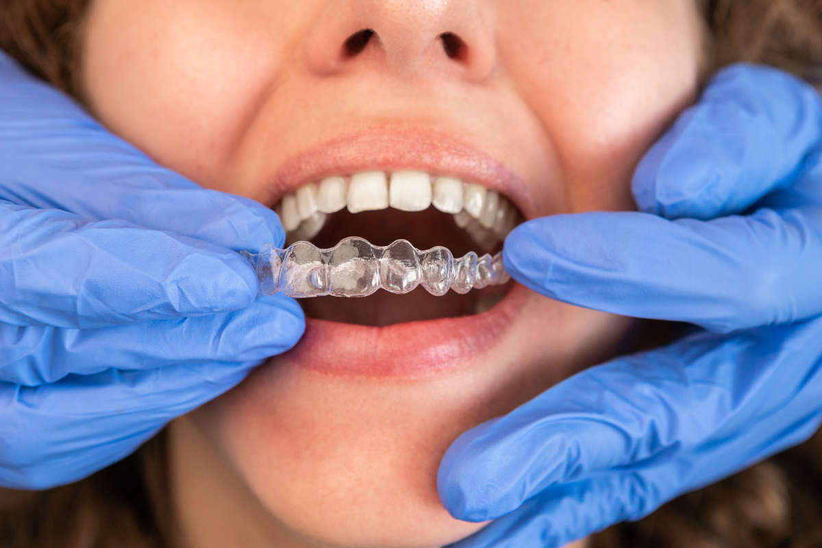 When Is It Time to Start Invisalign?